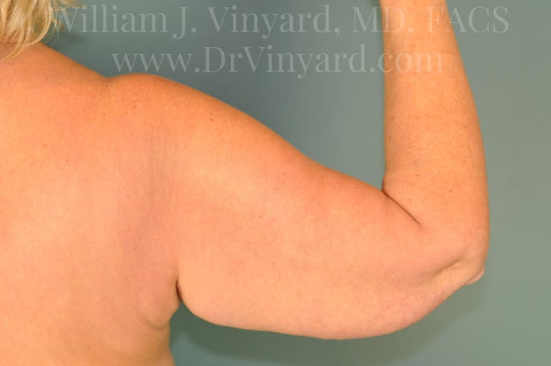 Arm Lift Before & After Gallery - Patient 169754907 - Image 5