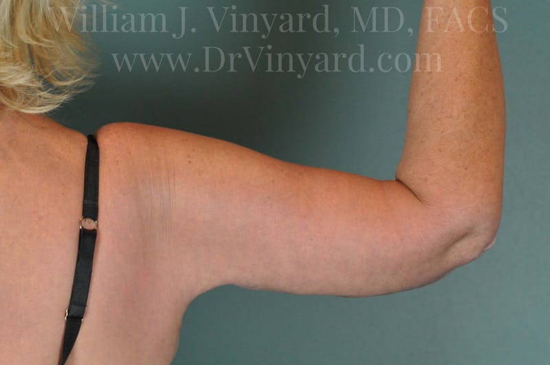 Arm Lift Before & After Gallery - Patient 169754907 - Image 6