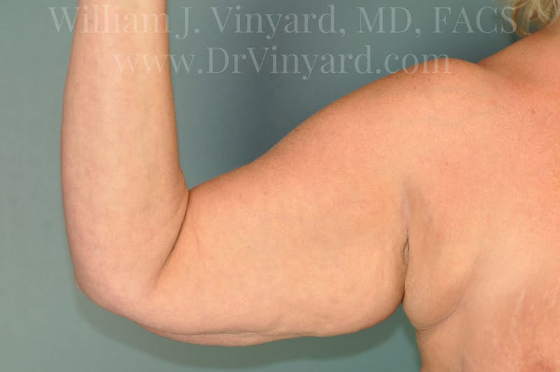 Arm Lift Before & After Gallery - Patient 169754907 - Image 7