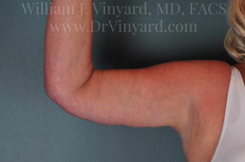 Arm Lift Before & After Gallery - Patient 169754907 - Image 8