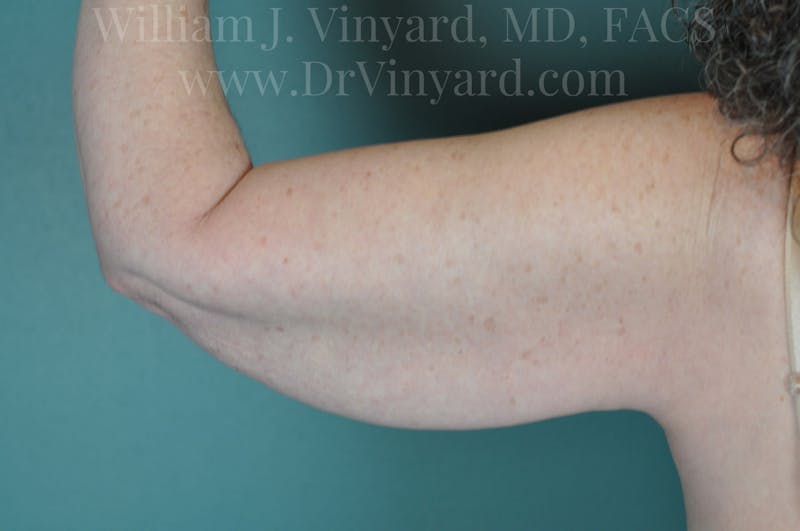 Arm Lift Before & After Gallery - Patient 169754908 - Image 1