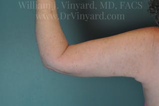 Arm Lift Before & After Gallery - Patient 169754908 - Image 2