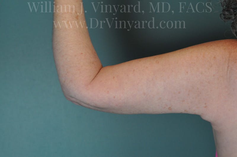Arm Lift Before & After Gallery - Patient 169754908 - Image 2