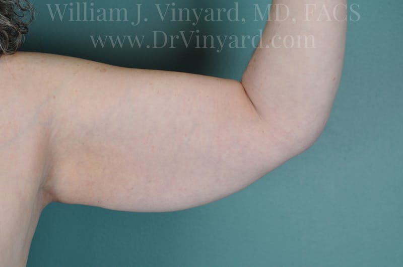 Arm Lift Before & After Gallery - Patient 169754908 - Image 3