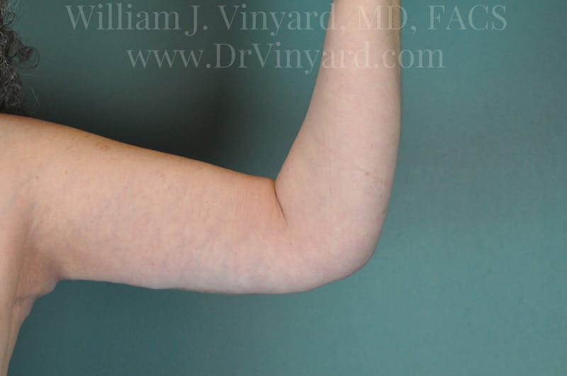 Arm Lift Before & After Gallery - Patient 169754908 - Image 4