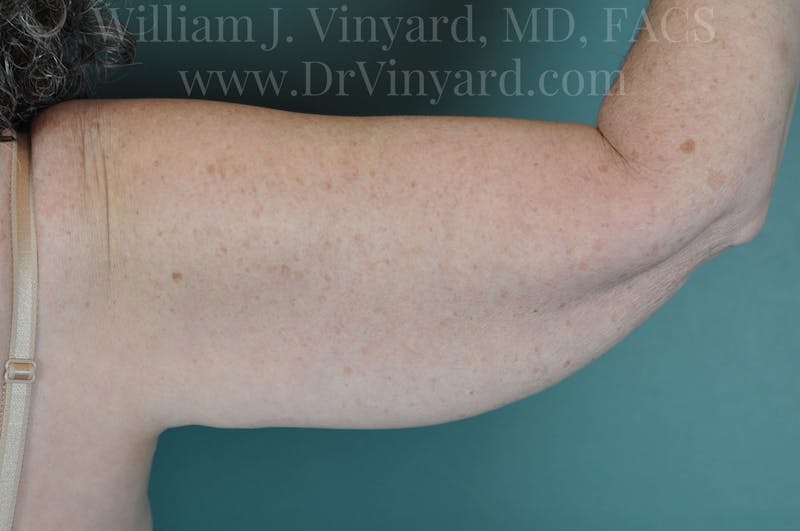 Arm Lift Before & After Gallery - Patient 169754908 - Image 5