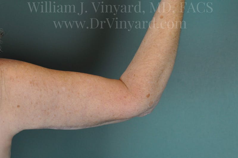 Arm Lift Before & After Gallery - Patient 169754908 - Image 6