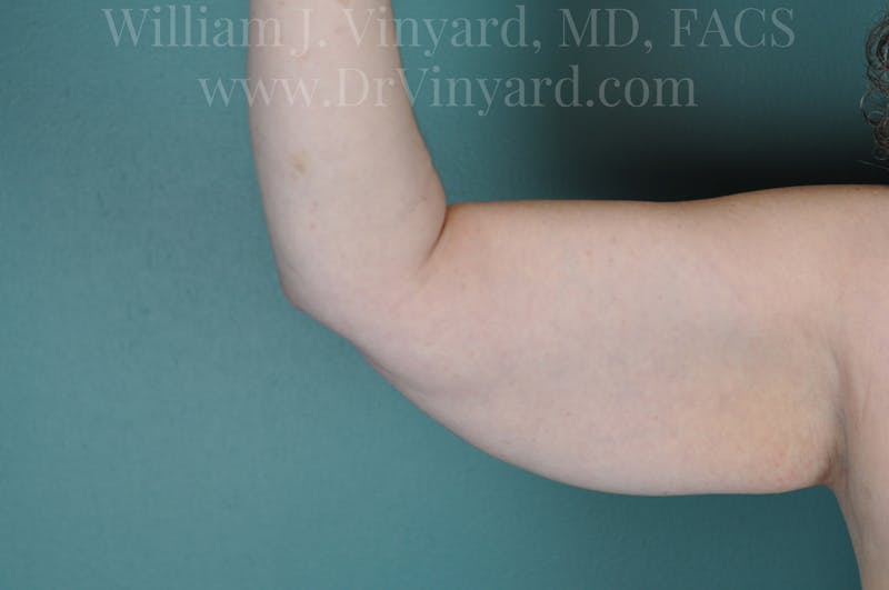 Arm Lift Before & After Gallery - Patient 169754908 - Image 7