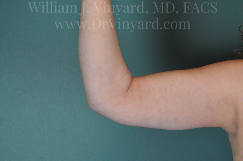 Arm Lift Before & After Gallery - Patient 169754908 - Image 8