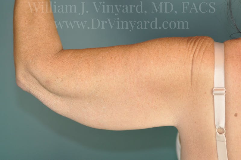Arm Lift Before & After Gallery - Patient 169755361 - Image 1
