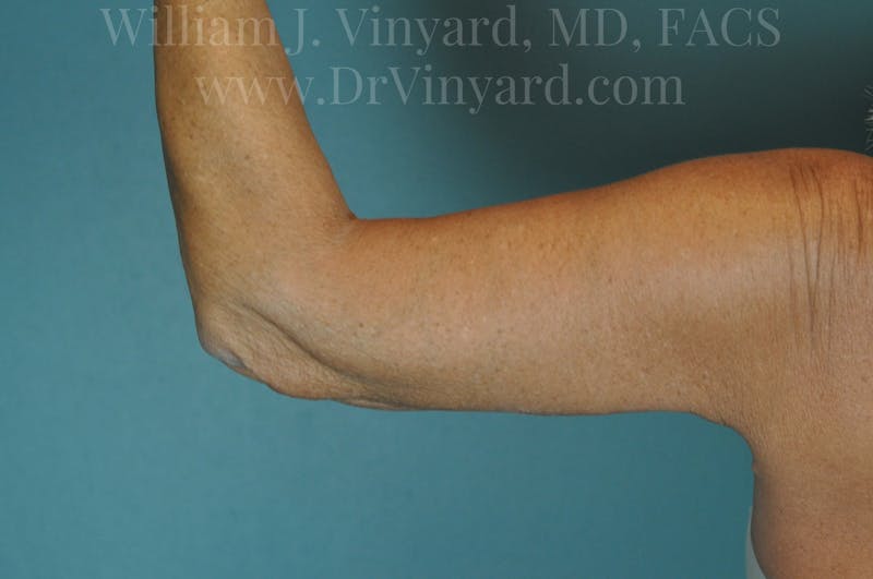 Arm Lift Before & After Gallery - Patient 169755361 - Image 2