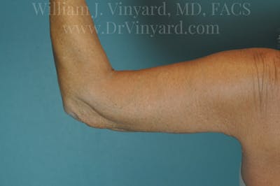 Arm Lift Before & After Gallery - Patient 169755361 - Image 2