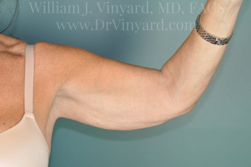 Arm Lift Before & After Gallery - Patient 169755361 - Image 3