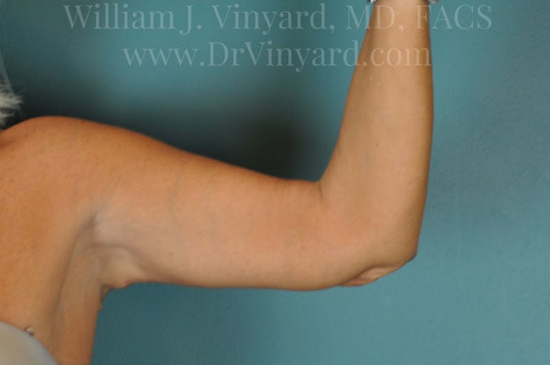 Arm Lift Before & After Gallery - Patient 169755361 - Image 4