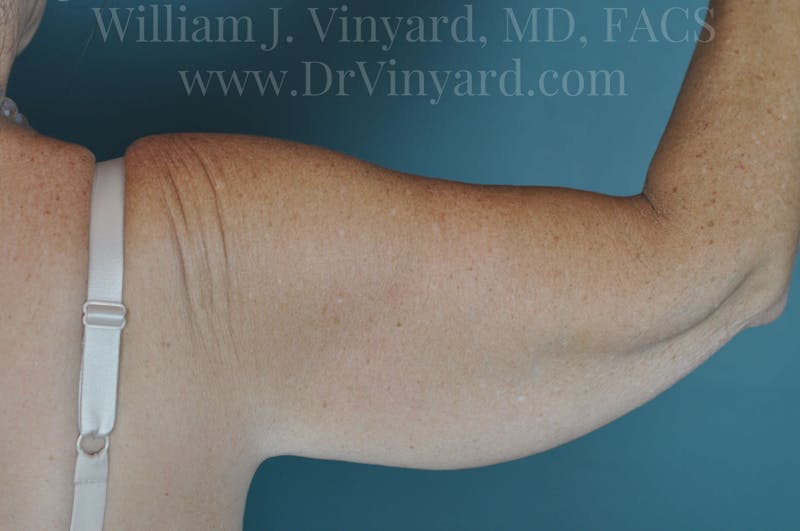 Arm Lift Before & After Gallery - Patient 169755361 - Image 5