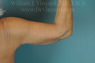Arm Lift Before & After Gallery - Patient 169755361 - Image 6