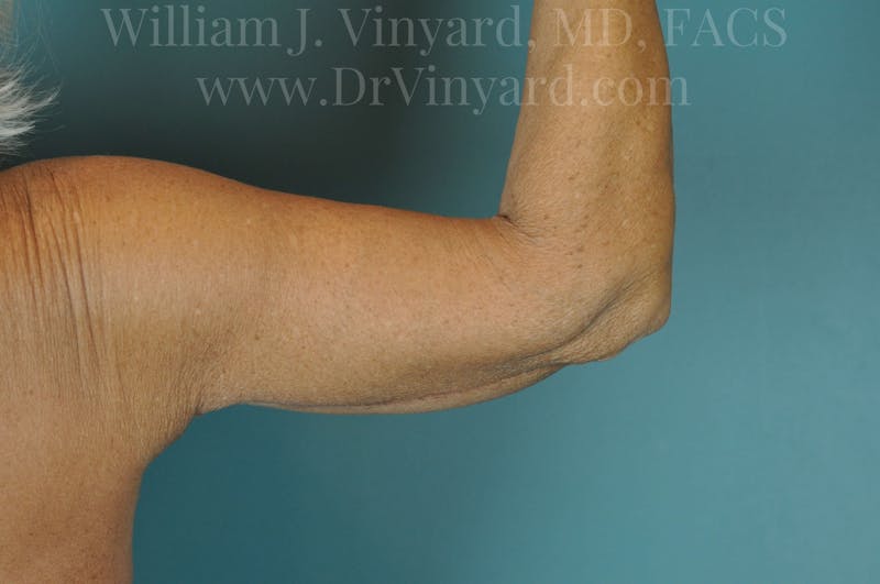Arm Lift Before & After Gallery - Patient 169755361 - Image 6