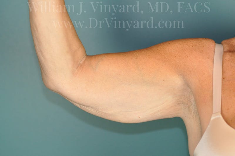 Arm Lift Before & After Gallery - Patient 169755361 - Image 7