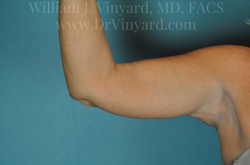 Arm Lift Before & After Gallery - Patient 169755361 - Image 8