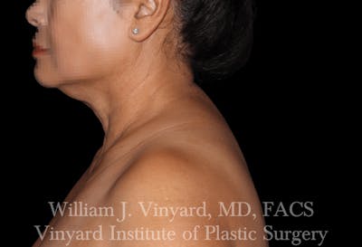 BODYTite / Liposuction Before & After Gallery - Patient 169755650 - Image 2