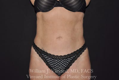 BODYTite / Liposuction Before & After Gallery - Patient 169755654 - Image 2