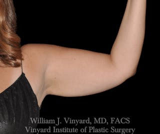 BODYTite / Liposuction Before & After Gallery - Patient 169755656 - Image 2