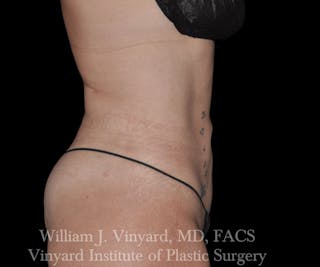 BodyTite Before & After Gallery - Patient 169755658 - Image 2