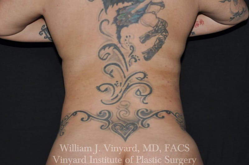 BodyTite Before & After Gallery - Patient 169755722 - Image 4