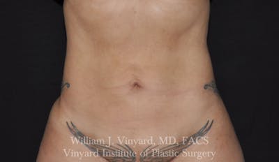 BodyTite Before & After Gallery - Patient 169755939 - Image 2
