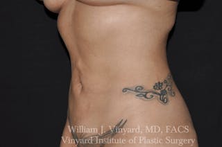 BodyTite Before & After Gallery - Patient 169755939 - Image 4