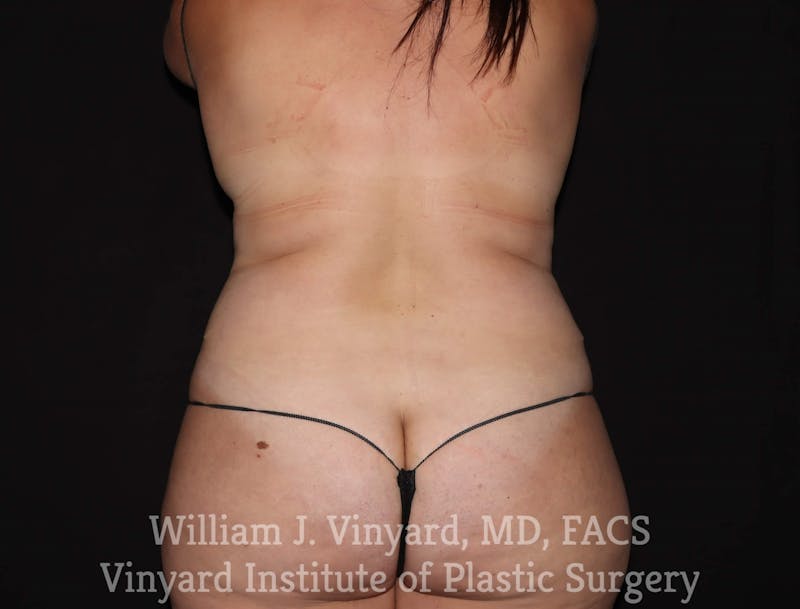 BodyTite Before & After Gallery - Patient 169756156 - Image 1