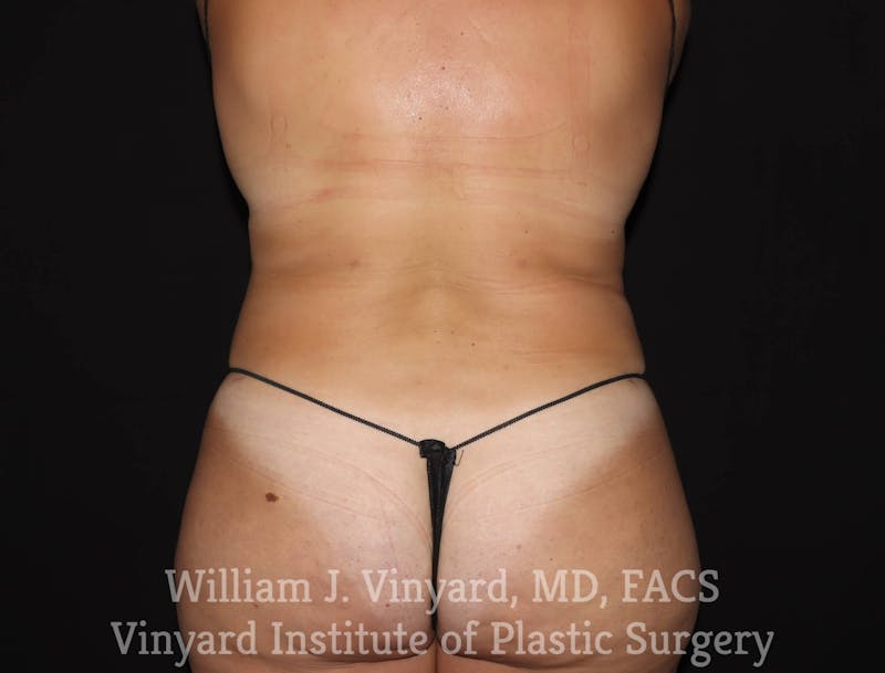BodyTite Before & After Gallery - Patient 169756156 - Image 2
