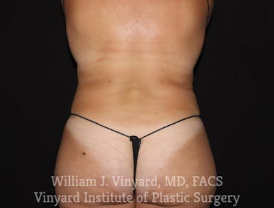 BODYTite / Liposuction Before & After Gallery - Patient 169756156 - Image 2