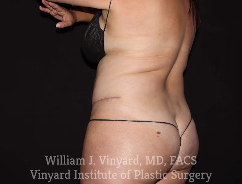 BodyTite Before & After Gallery - Patient 169756156 - Image 3