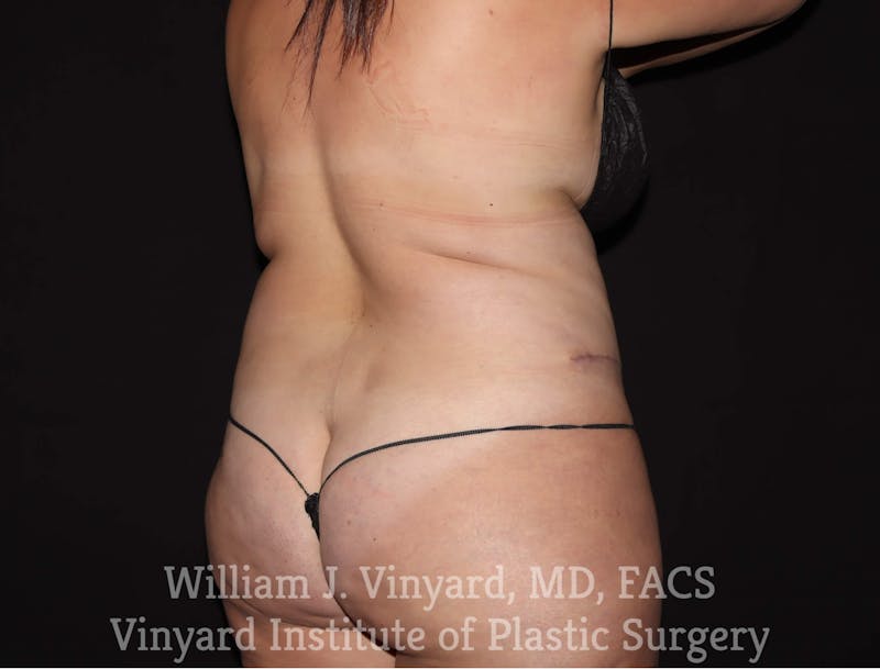 BodyTite Before & After Gallery - Patient 169756156 - Image 5