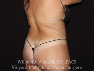 BodyTite Before & After Gallery - Patient 169756156 - Image 6