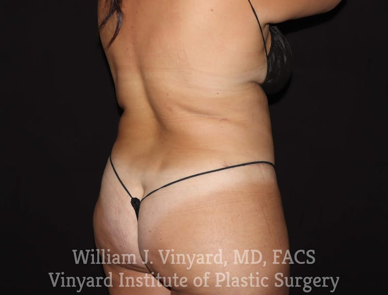 BodyTite Before & After Gallery - Patient 169756156 - Image 6