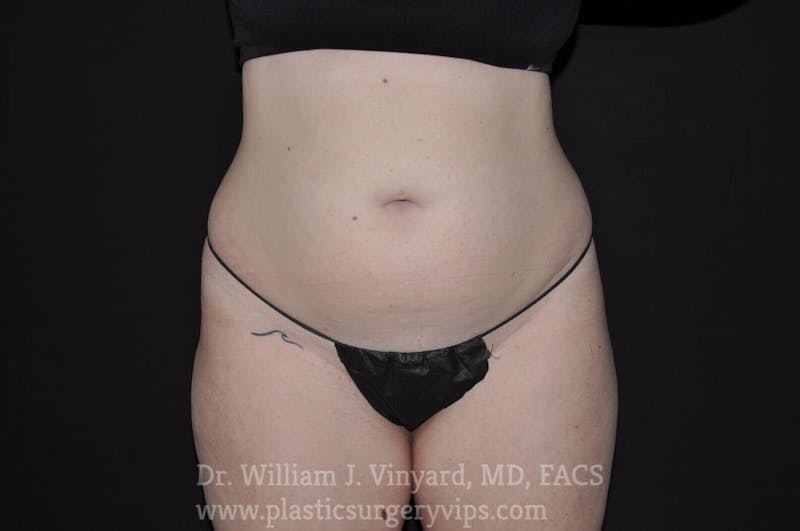 BodyTite Before & After Gallery - Patient 169756186 - Image 1