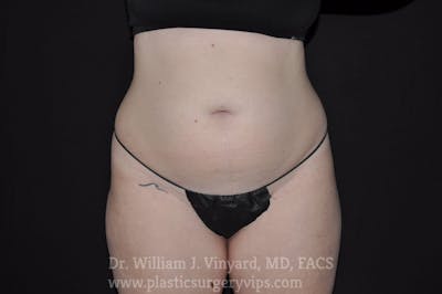 BodyTite Before & After Gallery - Patient 169756186 - Image 1