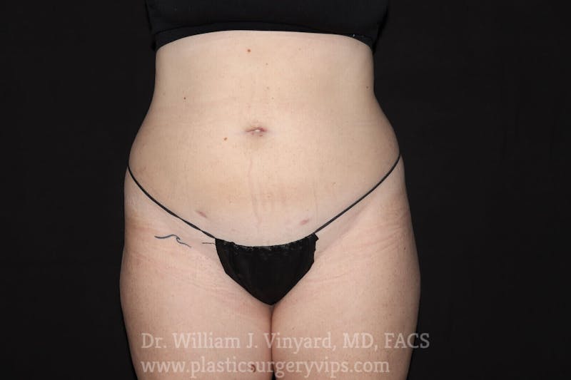 BodyTite Before & After Gallery - Patient 169756186 - Image 2