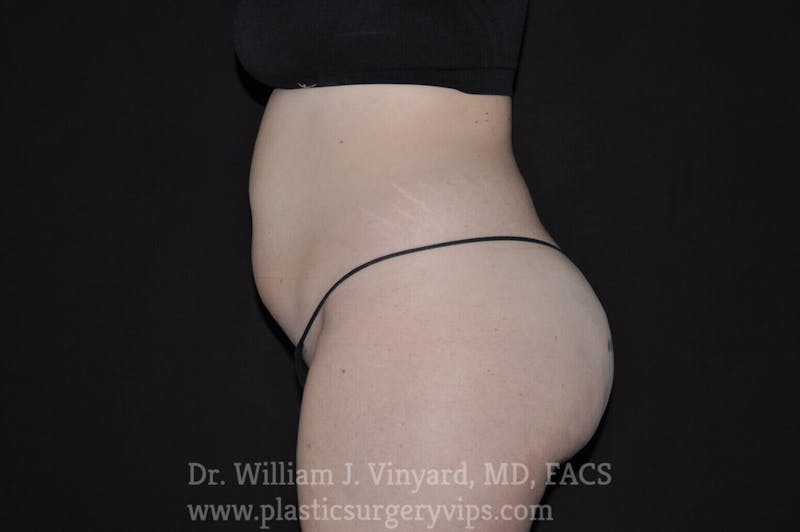 BodyTite Before & After Gallery - Patient 169756186 - Image 3