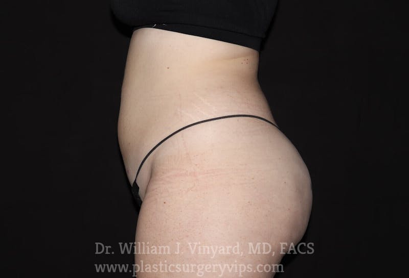 BodyTite Before & After Gallery - Patient 169756186 - Image 4