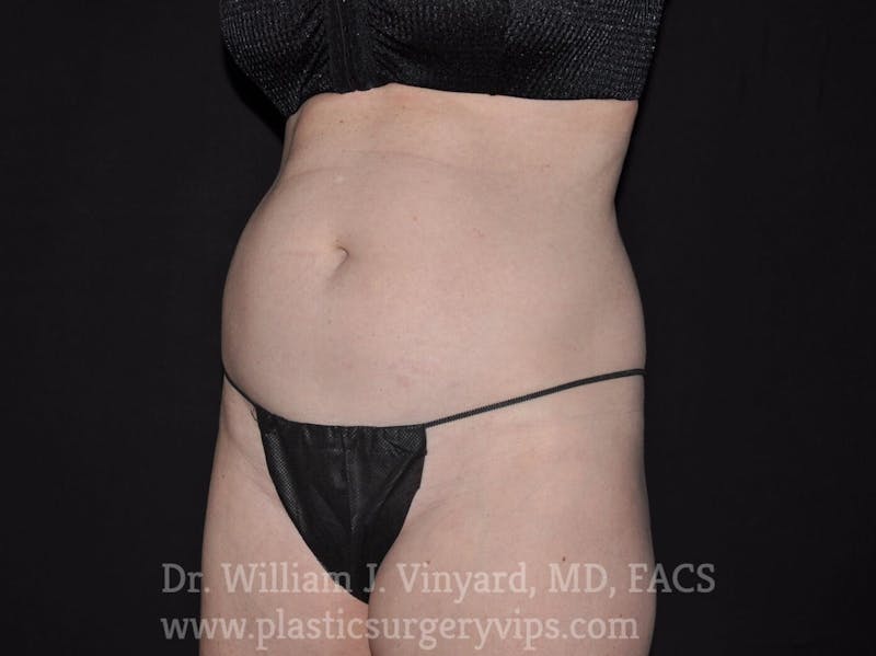 BodyTite Before & After Gallery - Patient 169756188 - Image 1