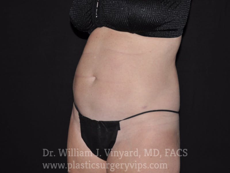 BodyTite Before & After Gallery - Patient 169756188 - Image 2
