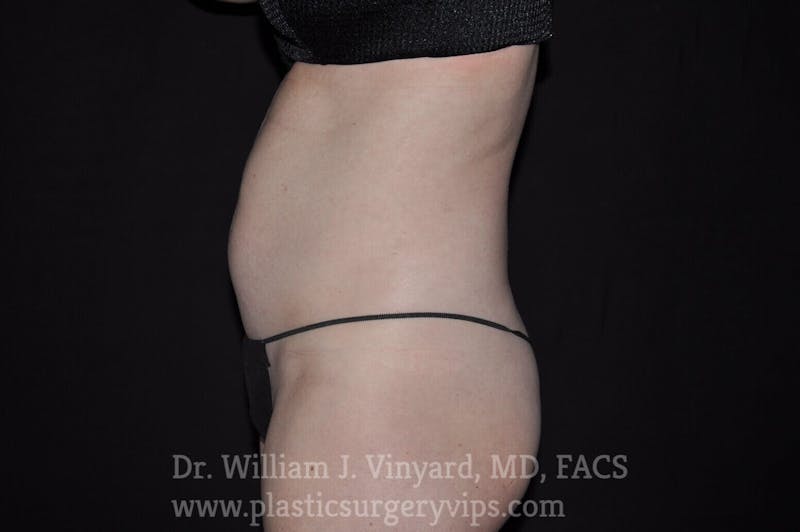 BodyTite Before & After Gallery - Patient 169756188 - Image 3