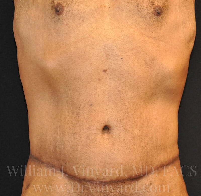 Lower Body Lift Before & After Gallery - Patient 169792926 - Image 2