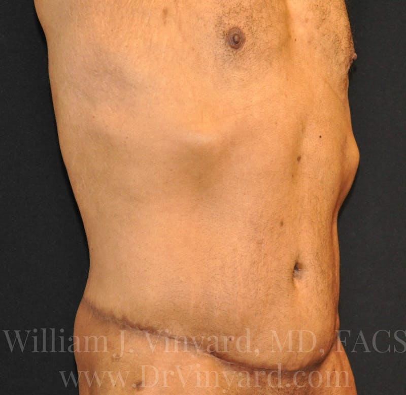 Lower Body Lift Before & After Gallery - Patient 169792926 - Image 4