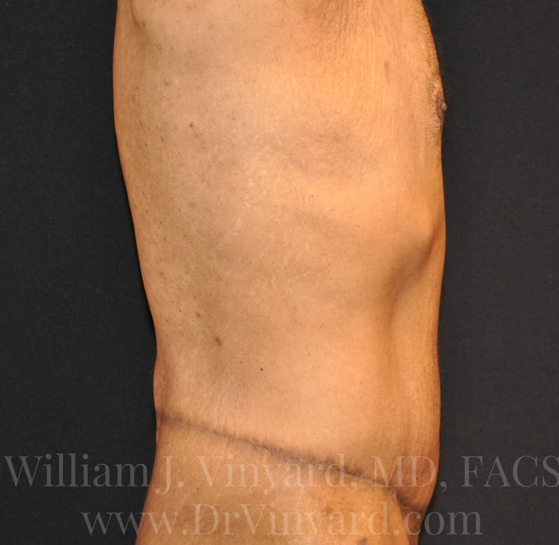 Lower Body Lift Before & After Gallery - Patient 169792926 - Image 6