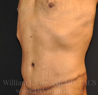 Lower Body Lift Before & After Gallery - Patient 169792926 - Image 8
