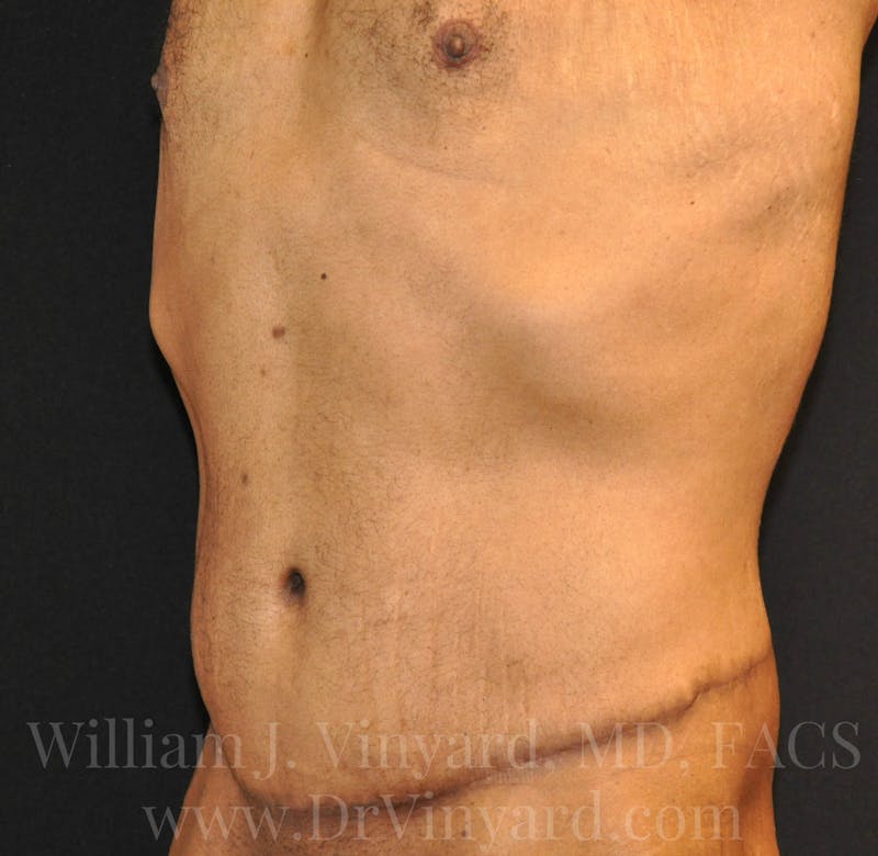 Lower Body Lift Before & After Gallery - Patient 169792926 - Image 8